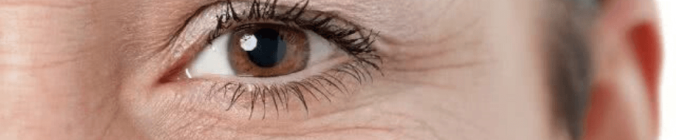 área dos olhos - rugas e linhas de expressao